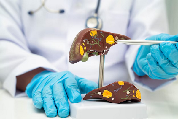 Hepatitis and Fatty Liver