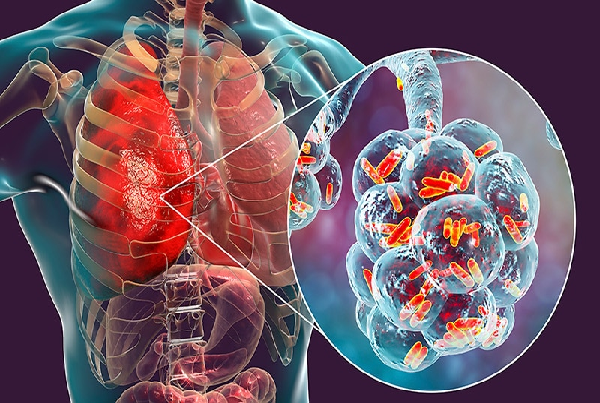 Tuberculosis and Pneumonia