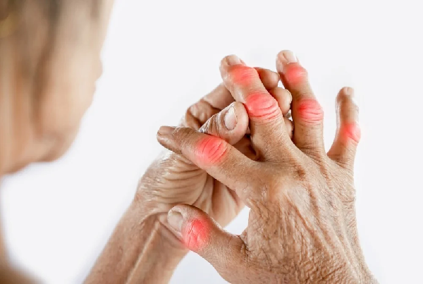 Arthritis Treatment