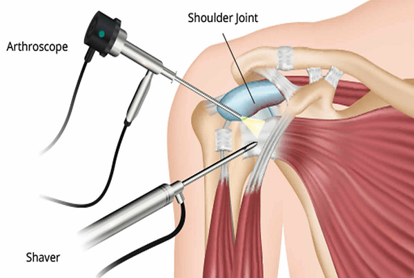 Shoulder Replacement